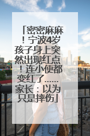 密密麻麻！宁波4岁孩子身上突然出现红点！连小便都变红了……家长：以为只是摔伤
